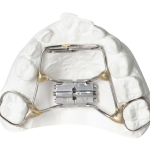 RPE with Tongue Crib