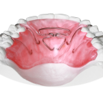 Spring Aligner 2